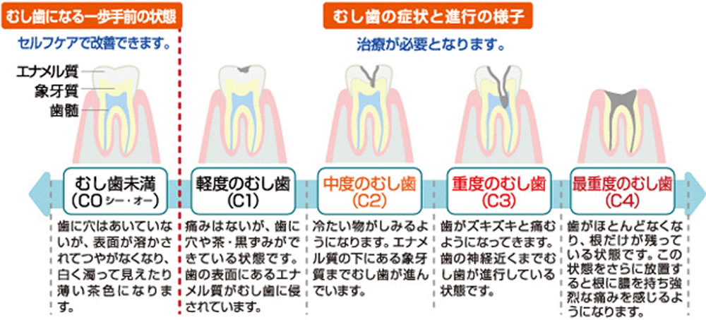 低侵襲虫歯治療