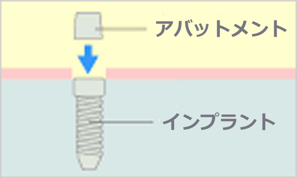 2次オペ