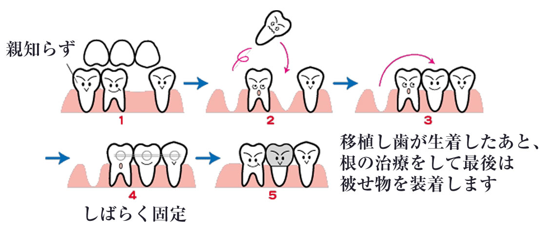 痛くない親知らずの抜歯・移植｜西新宿の歯科口腔外科 ...