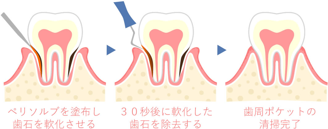 ペリソルブ