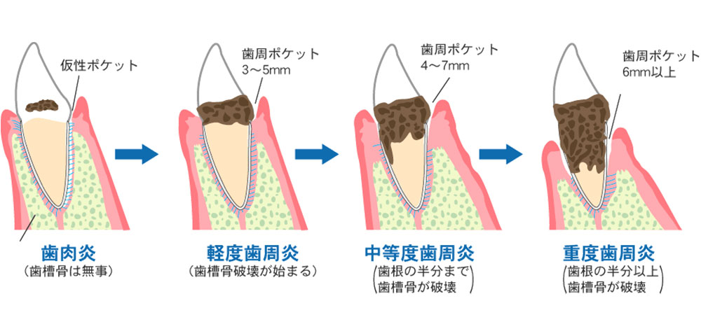 歯周病治療の方法