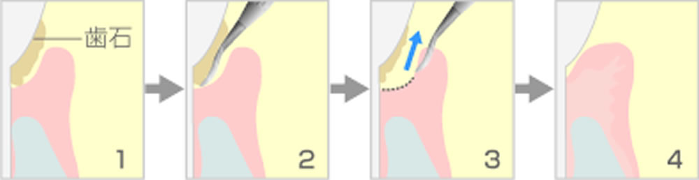 歯周ポケット掻爬術